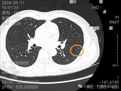 中国首个肺癌结节辅助诊断试剂盒获批上市